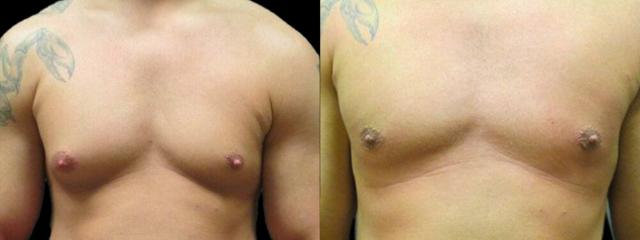 Gynecomastia Surgery result at Colgrove Plastic Surgery (Vinings) in Atlanta, GA