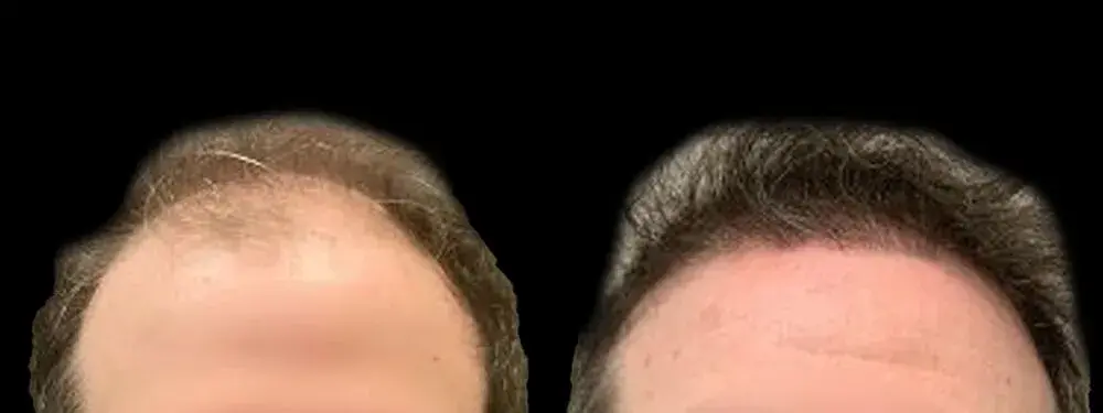 Colgrove Plastic Surgery (Vinings) hair restoration result — Atlanta, GA