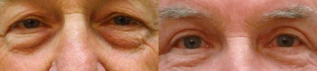 Blepharoplasty result at Colgrove Plastic Surgery (Vinings) in Atlanta, GA