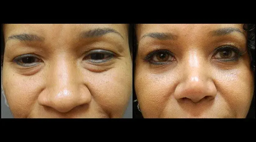 Colgrove Plastic Surgery (Vinings) rhinoplasty result — Atlanta, GA