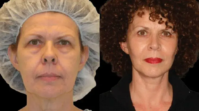 Colgrove Plastic Surgery (Vinings) facelift result — Atlanta, GA