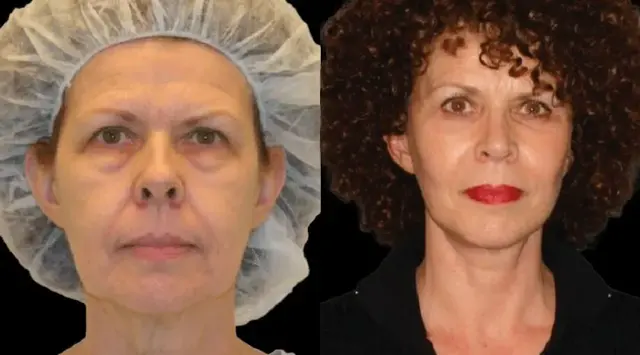 Facelift result at Colgrove Plastic Surgery (Vinings) in Atlanta, GA