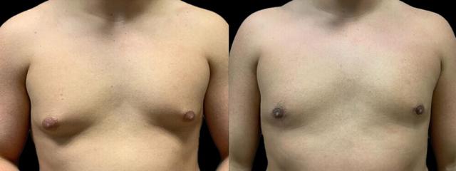 Gynecomastia Surgery result at Colgrove Plastic Surgery (Vinings) in Atlanta, GA