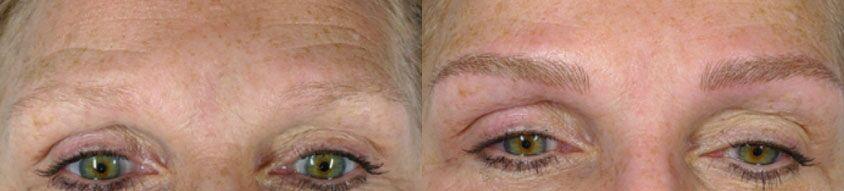 Colgrove Plastic Surgery (Vinings) blepharoplasty result — Atlanta, GA