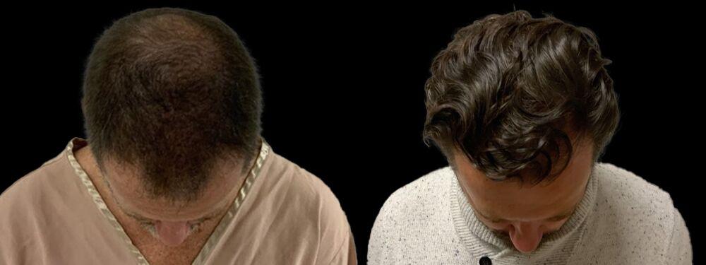 Colgrove Plastic Surgery (Vinings) hair restoration result — Atlanta, GA