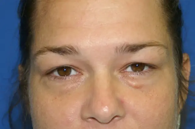 Blepharoplasty before at Bernard A. Shuster, MD, FACS in Hollywood, FL