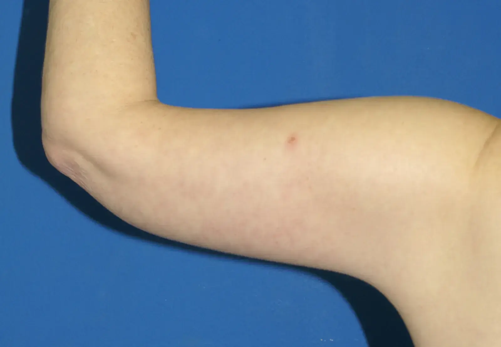 Bernard A. Shuster, MD, FACS arm lift after — Hollywood, FL