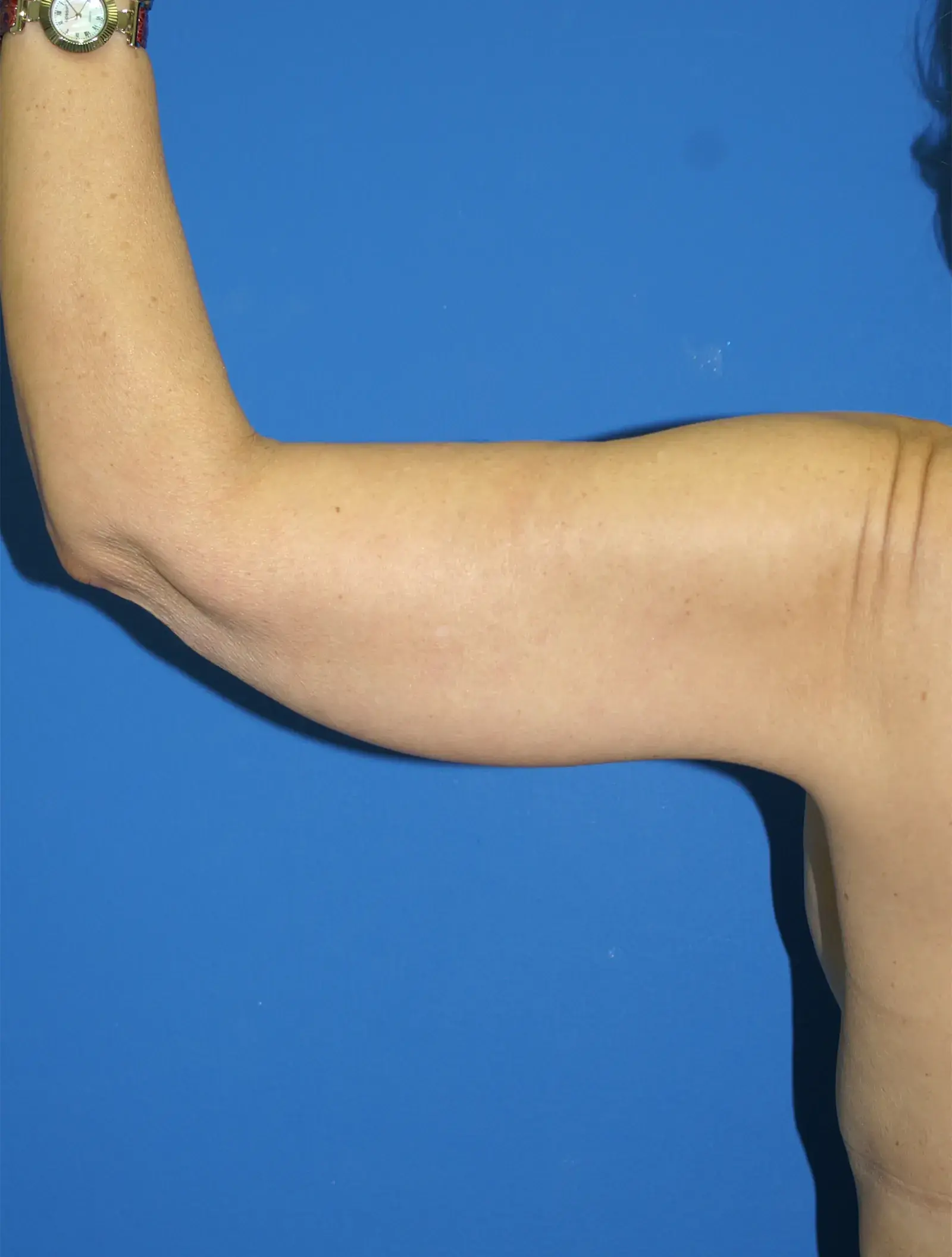 Bernard A. Shuster, MD, FACS arm lift after — Hollywood, FL