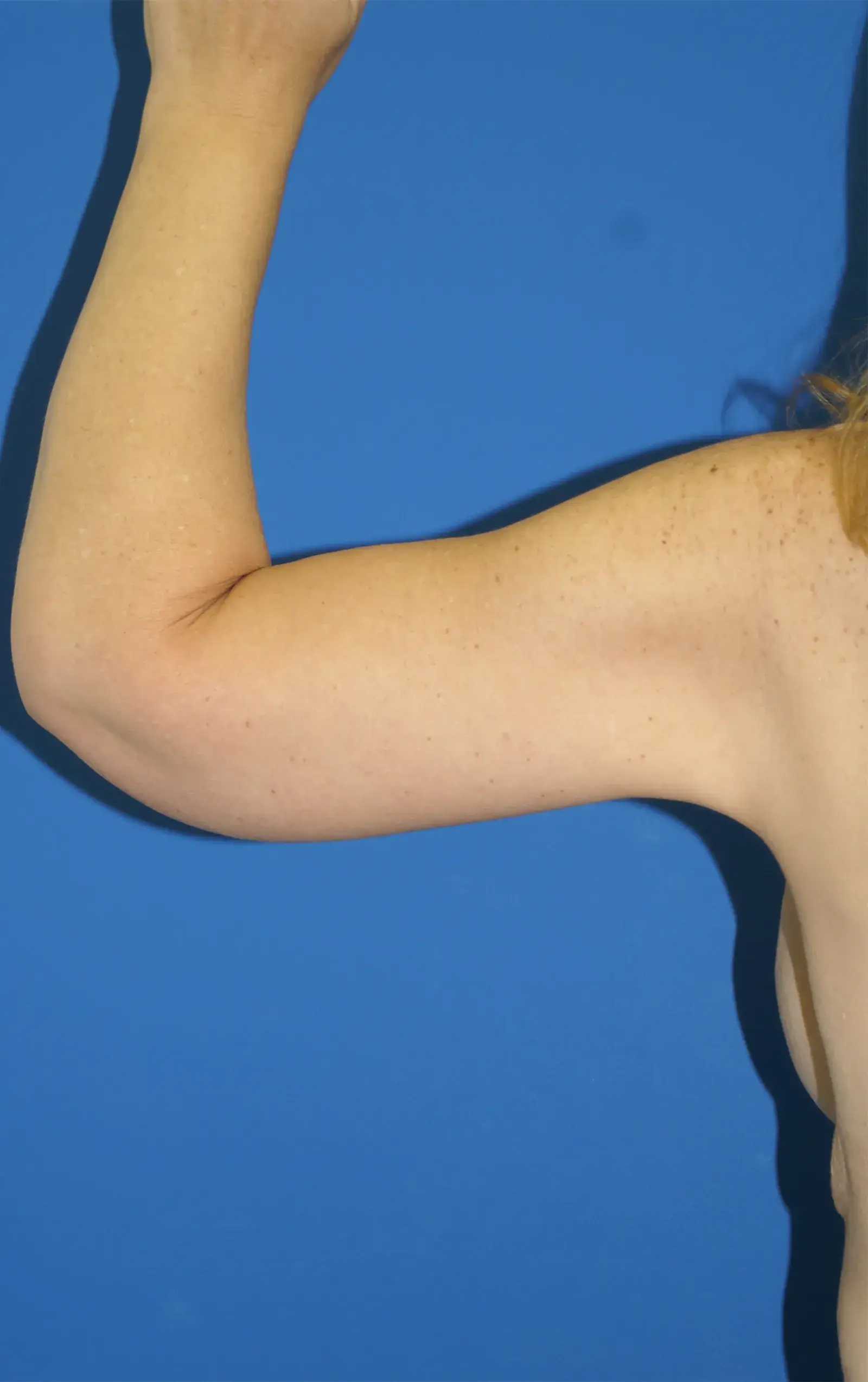 Bernard A. Shuster, MD, FACS arm lift after — Hollywood, FL