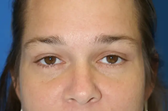 Blepharoplasty after at Bernard A. Shuster, MD, FACS in Hollywood, FL
