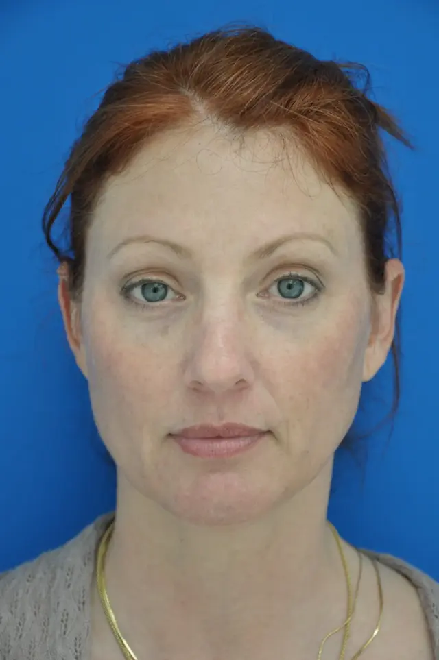 Mini Facelift before at Bernard A. Shuster, MD, FACS in Hollywood, FL