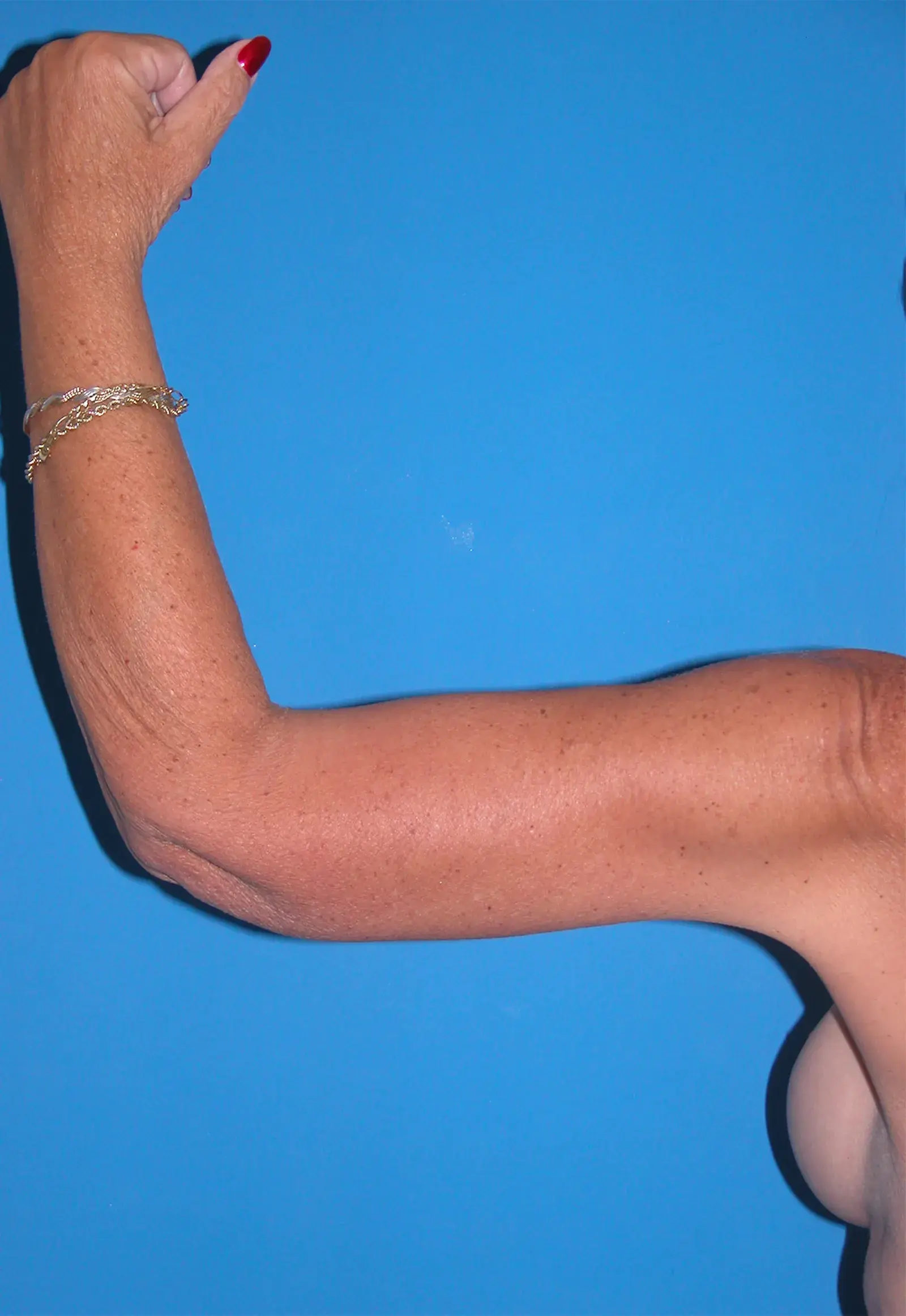 Bernard A. Shuster, MD, FACS arm lift after — Hollywood, FL
