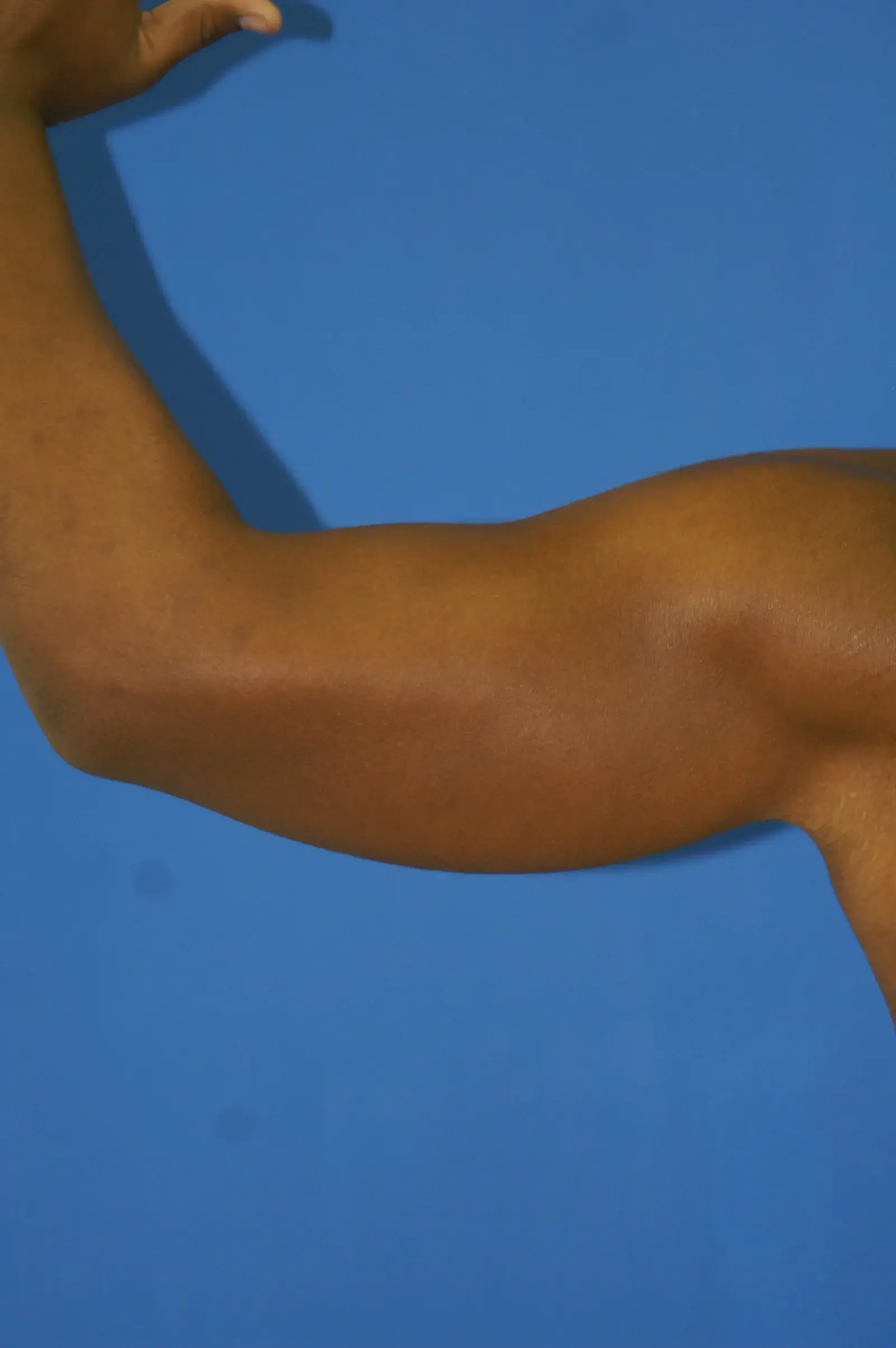 Bernard A. Shuster, MD, FACS arm lift after — Hollywood, FL