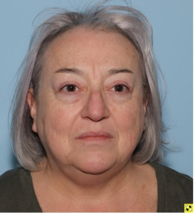 Art Plastic Surgery eyelid lift after — Paramus, NJ