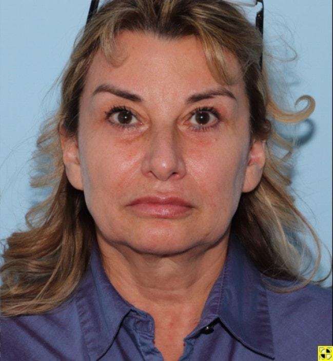 Art Plastic Surgery eyelid lift after — Paramus, NJ