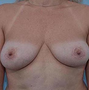 Art Plastic Surgery breast augmentation revision after — Paramus, NJ