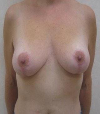 Art Plastic Surgery breast lift after — Paramus, NJ
