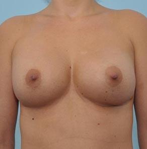 Art Plastic Surgery breast augmentation revision after — Paramus, NJ
