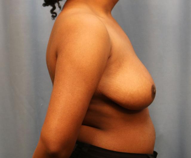 Breast Reduction after at Michael Spann, MD: Little Rock Plastic Surgery in Little Rock, AR