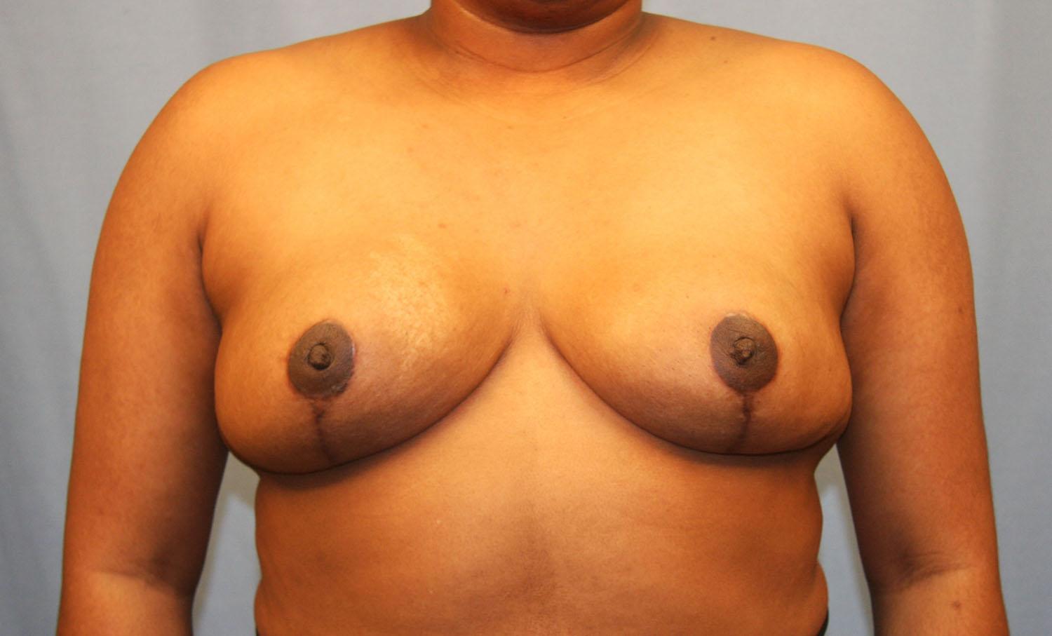 Michael Spann, MD: Little Rock Plastic Surgery after — Little Rock, AR