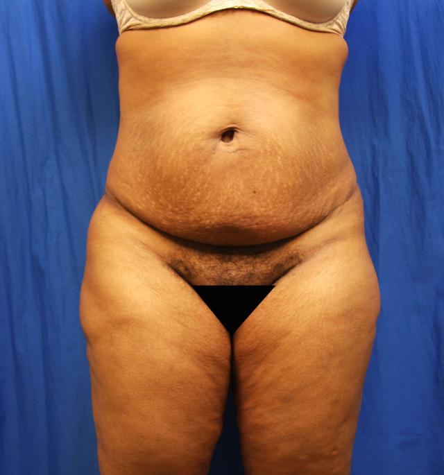 Mini Tummy Tuck before at Michael Spann, MD: Little Rock Plastic Surgery in Little Rock, AR