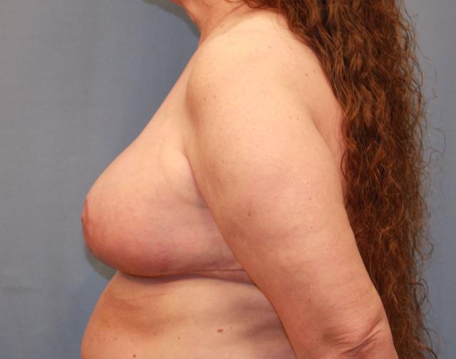 Breast Reduction after at Michael Spann, MD: Little Rock Plastic Surgery in Little Rock, AR