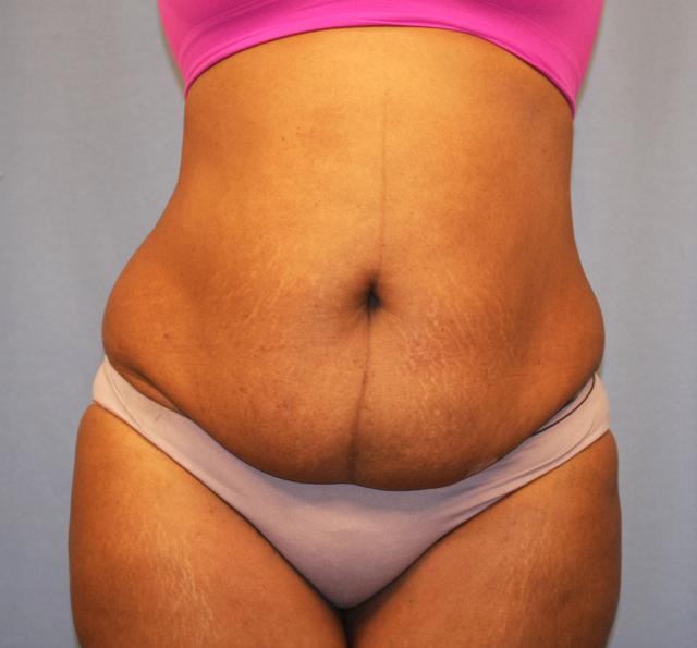 Mini Tummy Tuck before at Michael Spann, MD: Little Rock Plastic Surgery in Little Rock, AR