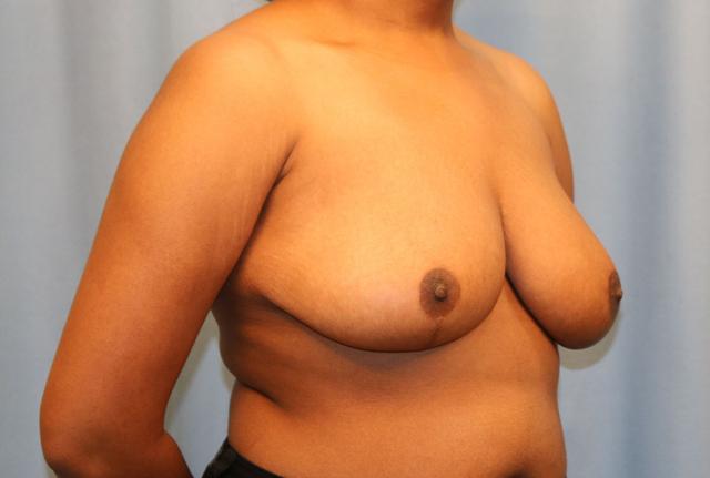 Breast Reduction after at Michael Spann, MD: Little Rock Plastic Surgery in Little Rock, AR