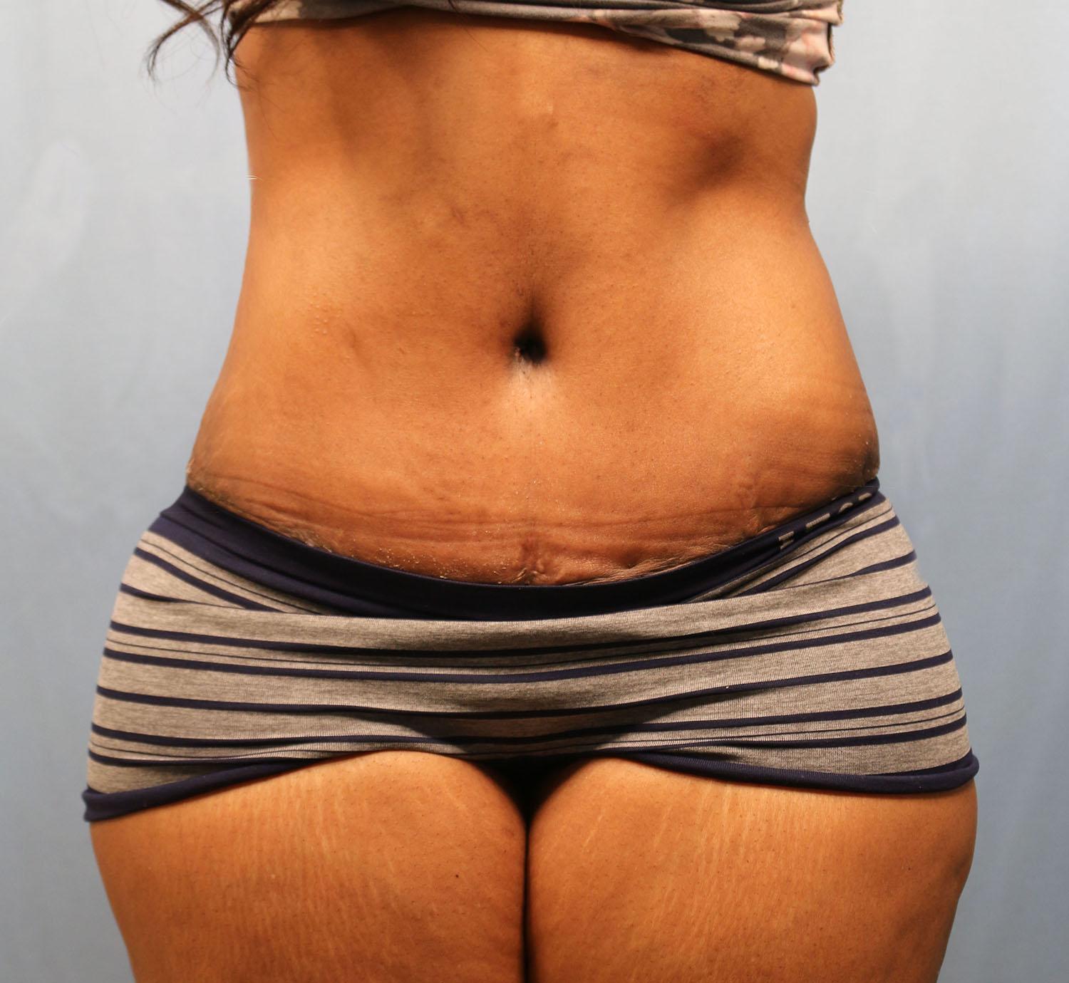 Michael Spann, MD: Little Rock Plastic Surgery tummy tuck after — Little Rock, AR