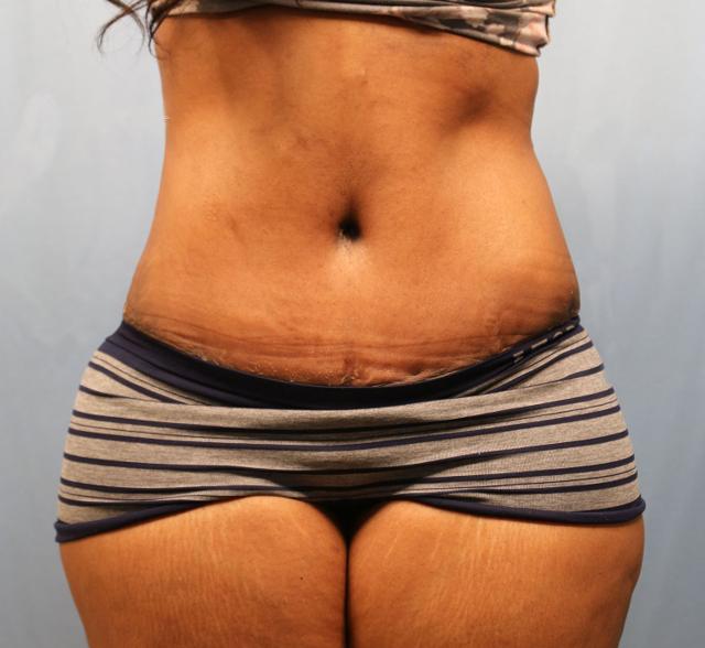 Mini Tummy Tuck after at Michael Spann, MD: Little Rock Plastic Surgery in Little Rock, AR