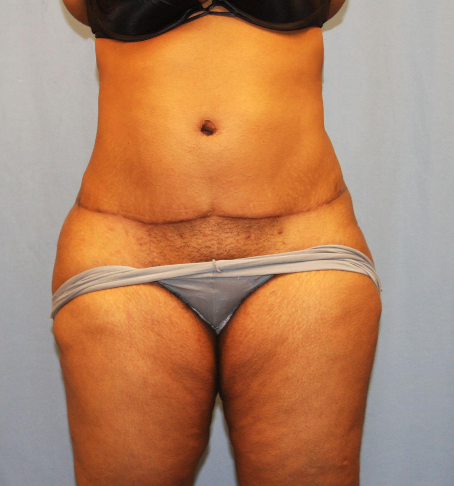 Michael Spann, MD: Little Rock Plastic Surgery after — Little Rock, AR