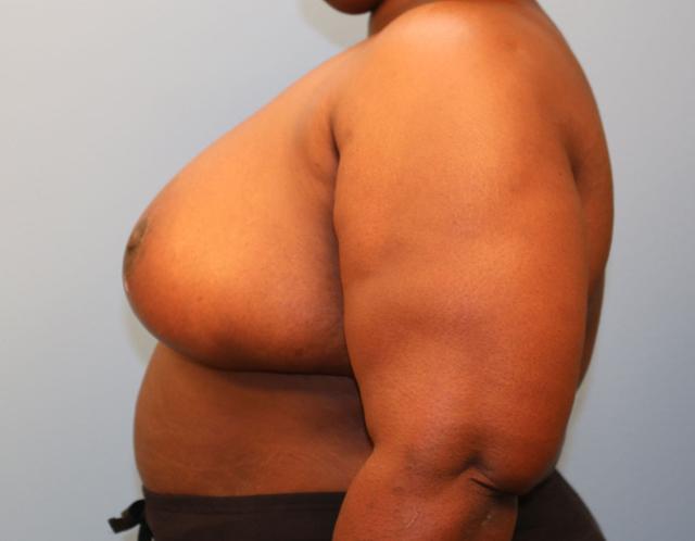 Breast Reduction after at Michael Spann, MD: Little Rock Plastic Surgery in Little Rock, AR