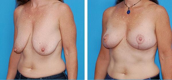 Breast Lift result at Boulder Plastic Surgery in Boulder, CO