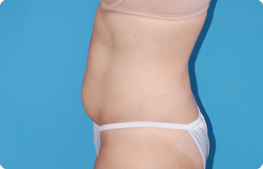 Liposuction before at Boulder Plastic Surgery in Boulder, CO