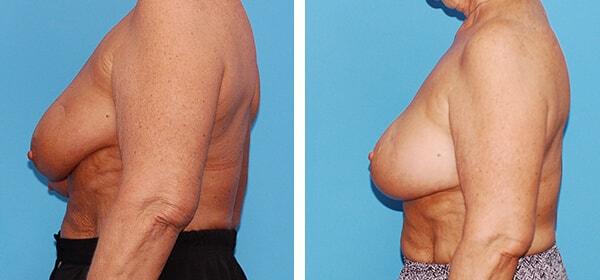 Breast Lift result at Boulder Plastic Surgery in Boulder, CO