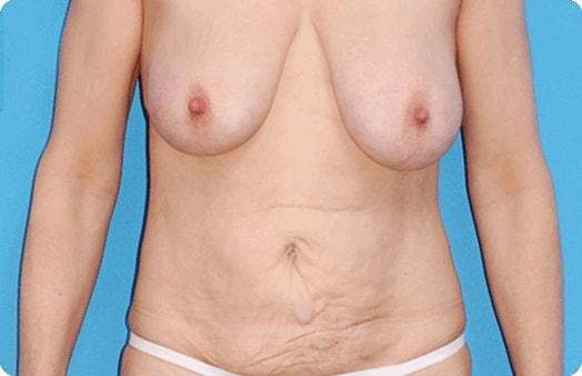 Mommy Makeover before at Boulder Plastic Surgery in Boulder, CO