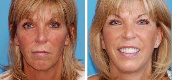 Boulder Plastic Surgery neck lift result — Boulder, CO