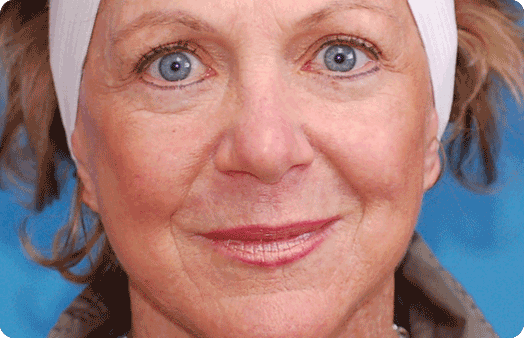 Boulder Plastic Surgery facelift after — Boulder, CO