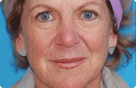 Mini Facelift before at Boulder Plastic Surgery in Boulder, CO