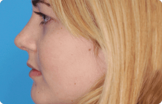 Boulder Plastic Surgery rhinoplasty after — Boulder, CO