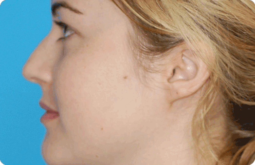 Functional Rhinoplasty before at Boulder Plastic Surgery in Boulder, CO
