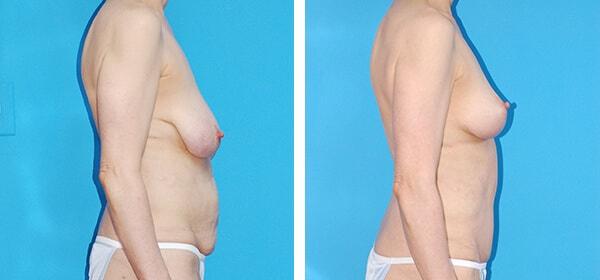 Mommy Makeover result at Boulder Plastic Surgery in Boulder, CO
