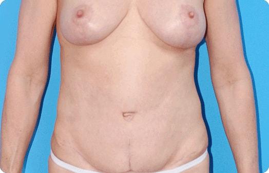 Mommy Makeover after at Boulder Plastic Surgery in Boulder, CO