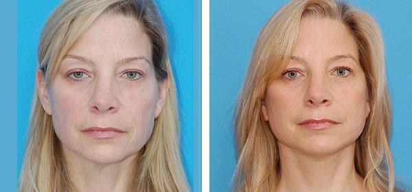 Boulder Plastic Surgery neck lift result — Boulder, CO