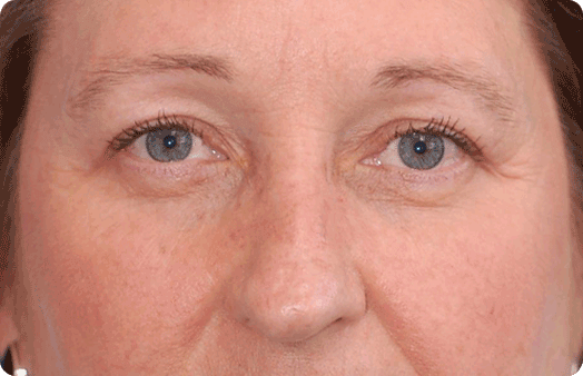 Boulder Plastic Surgery blepharoplasty after — Boulder, CO