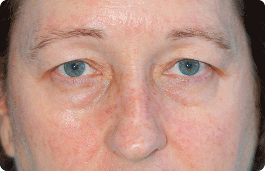 Blepharoplasty before at Boulder Plastic Surgery in Boulder, CO