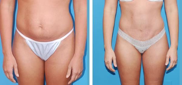 Tummy Tuck result at Boulder Plastic Surgery in Boulder, CO