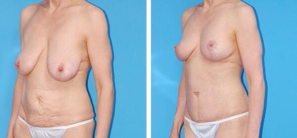Mommy Makeover result at Boulder Plastic Surgery in Boulder, CO
