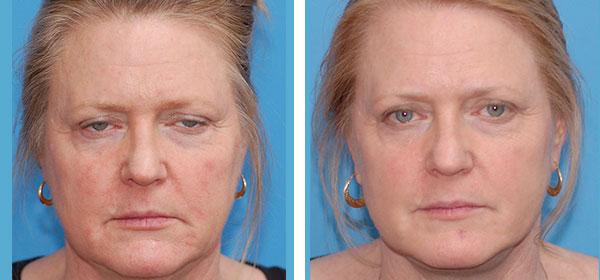 Boulder Plastic Surgery neck lift result — Boulder, CO