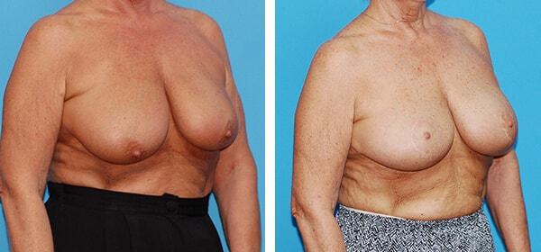 Breast Lift result at Boulder Plastic Surgery in Boulder, CO